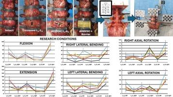 Reducing facet joint overload with a Kevlar-augmented lumbar disc replacement: An ex vivo investigation