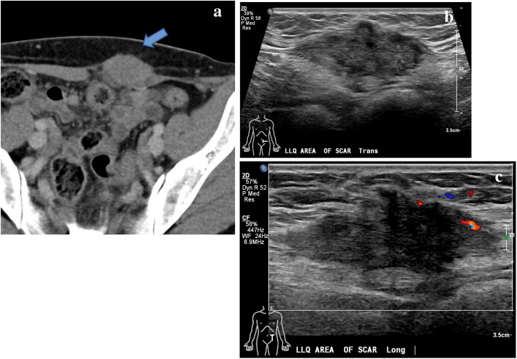 Benign granular cell tumor of the abdominal wall mimicking postpartum desmoid tumor.