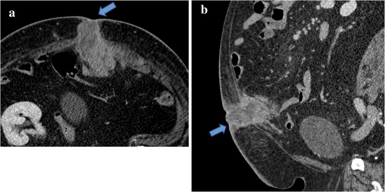 Benign granular cell tumor of the abdominal wall mimicking postpartum desmoid tumor.