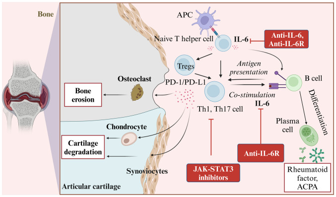 Blocking the IL‑6 pathway to treat immune checkpoint inhibitor‑induced inflammatory arthritis (Review).