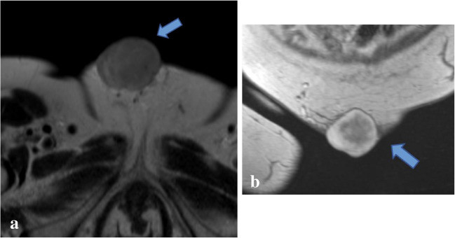 Benign granular cell tumor of the abdominal wall mimicking postpartum desmoid tumor.