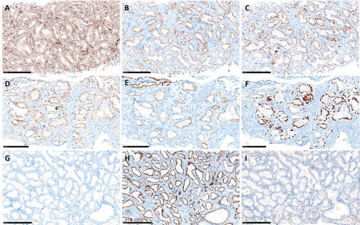 Role of Cell-Cycle Proliferation Test, Triple Hit Phenotype, and TMPRSS2-ERG Expression to Evaluate the Risk of Progression in Prostate Cancer Patients Under Active Surveillance.