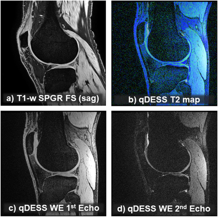 Multifaceted imaging strategies for clinical trials of knee osteoarthritis-a tightly interlinked value and precision chain.
