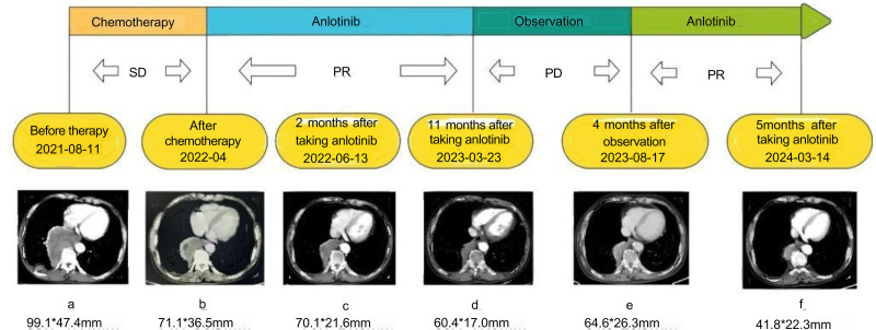 Anlotinib for the treatment of pulmonary epithelioid inflammatory myofibroblastic sarcoma: a case report.