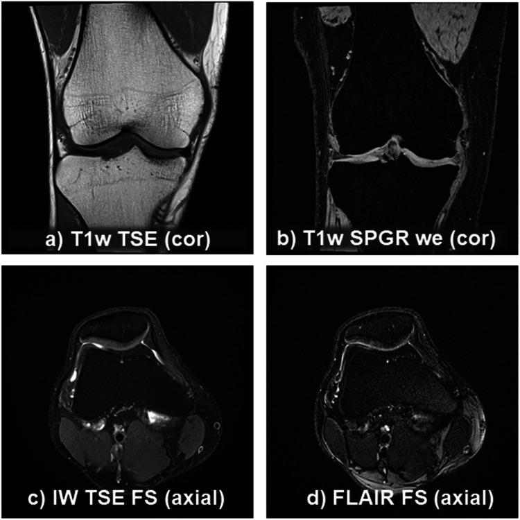 Multifaceted imaging strategies for clinical trials of knee osteoarthritis-a tightly interlinked value and precision chain.