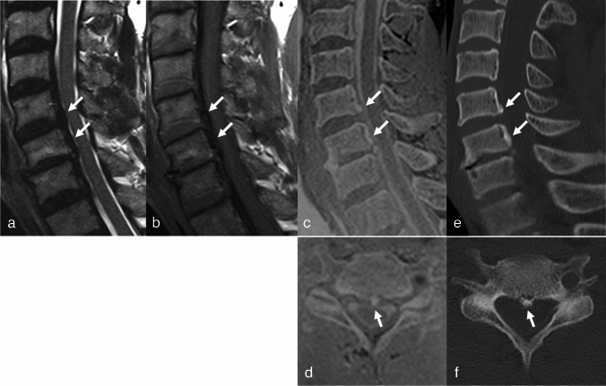 CT-like image based on 3D fast low-angle shot: superior diagnostic performance of ossification of the posterior longitudinal ligament.