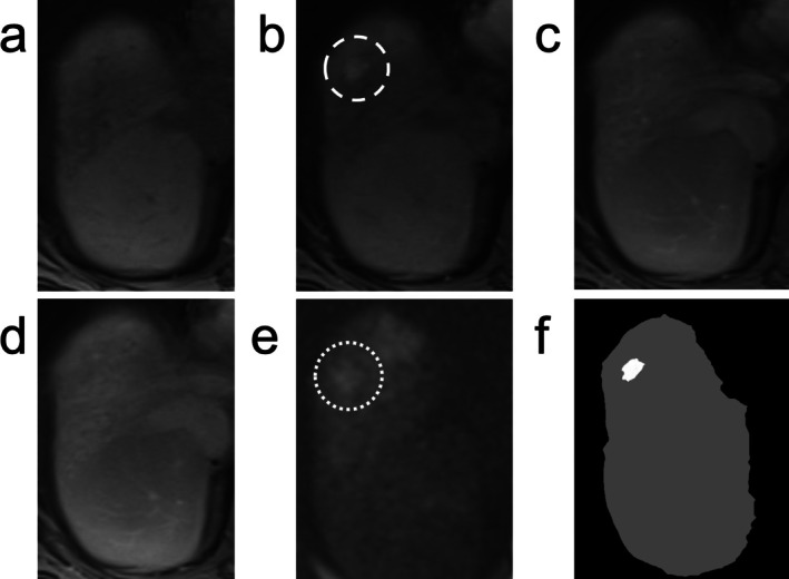 Current State of Evidence for Use of MRI in LI-RADS.