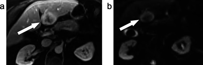 Current State of Evidence for Use of MRI in LI-RADS.