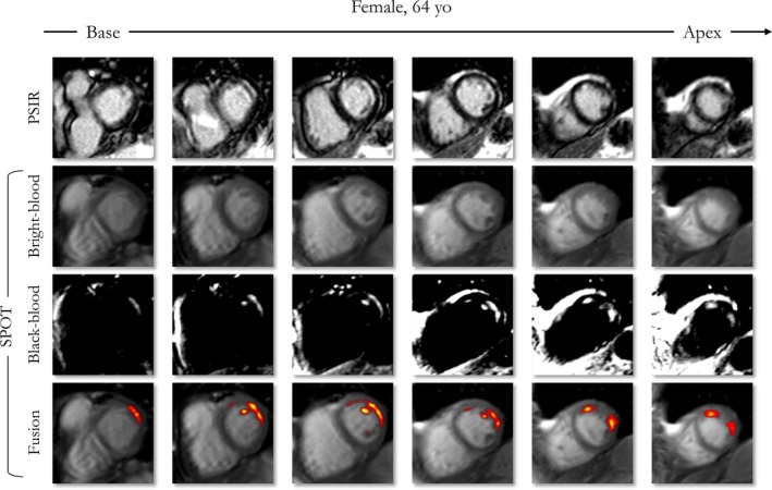 Improved and Automated Detection of Papillary Muscle Infarction Using Joint Bright- and Black-Blood Late Gadolinium Enhancement MRI.