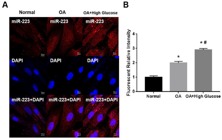Micro-223 Promotes Diabetic Osteoarthritis Progression by Regulating Cartilage Degeneration and Subchondral Bone Remodeling.