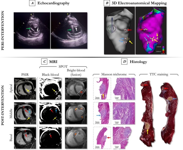 Improved and Automated Detection of Papillary Muscle Infarction Using Joint Bright- and Black-Blood Late Gadolinium Enhancement MRI.