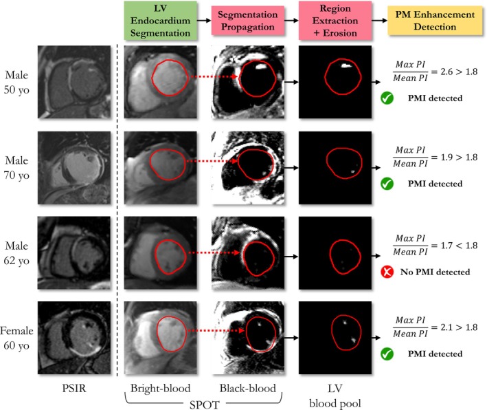 Improved and Automated Detection of Papillary Muscle Infarction Using Joint Bright- and Black-Blood Late Gadolinium Enhancement MRI.