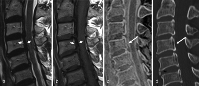 CT-like image based on 3D fast low-angle shot: superior diagnostic performance of ossification of the posterior longitudinal ligament.