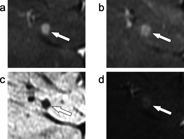 Current State of Evidence for Use of MRI in LI-RADS.