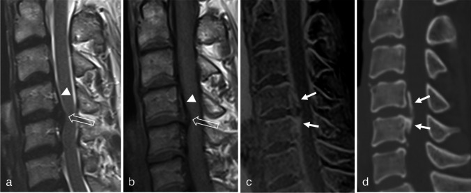 CT-like image based on 3D fast low-angle shot: superior diagnostic performance of ossification of the posterior longitudinal ligament.