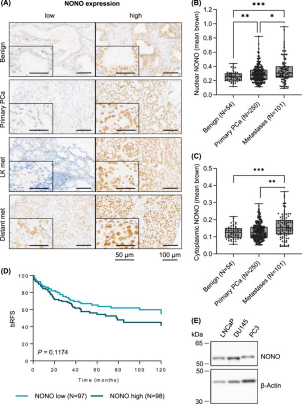 Downregulation of NONO Suppresses Proliferation, Migration, and Invasion in Metastatic Prostate Cancer.