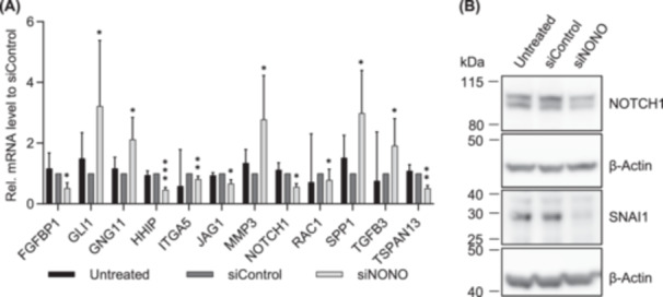 Downregulation of NONO Suppresses Proliferation, Migration, and Invasion in Metastatic Prostate Cancer.