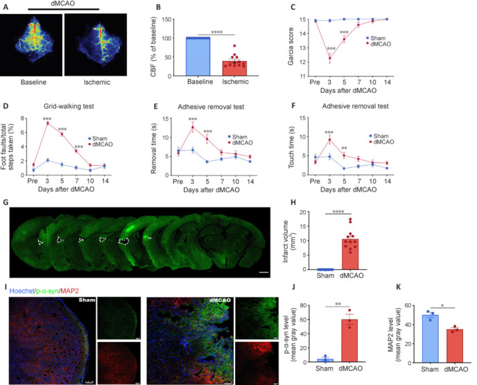 Decreased levels of phosphorylated synuclein in plasma are correlated with poststroke cognitive impairment.