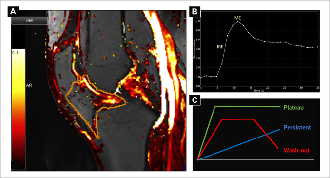 The association between articular calcium crystal deposition and knee osteoarthritis, joint pain and inflammation: a cross-sectional study.