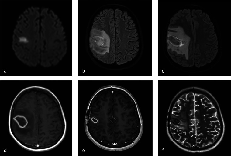 Intracranial <i>Rhizomucor Pusillus</i> Mucormycosis in an Adolescent Triggering a Stroke Alert: A Case Report and a Systematic Review of Pediatric Cases.