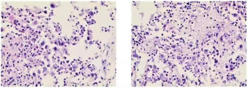 Anlotinib for the treatment of pulmonary epithelioid inflammatory myofibroblastic sarcoma: a case report.