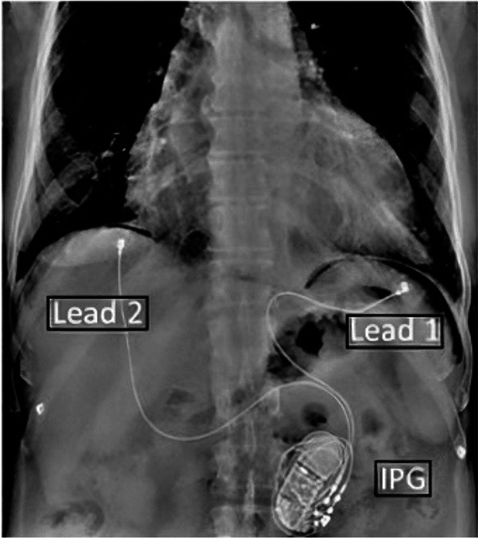 Synchronized diaphragmatic stimulation for the treatment of HFrEF-a review.