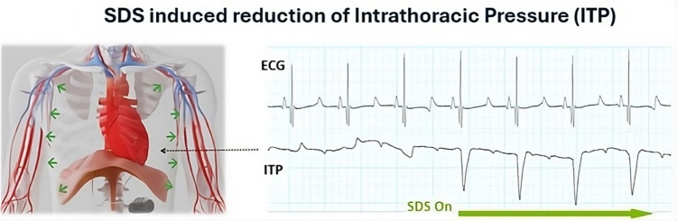Synchronized diaphragmatic stimulation for the treatment of HFrEF-a review.