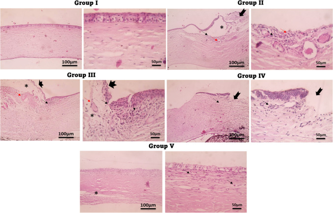 Nano-spanlastics-loaded dissolving microneedle patches for ketotifen fumarate: advanced strategies for allergic conjunctivitis treatment and molecular insights.