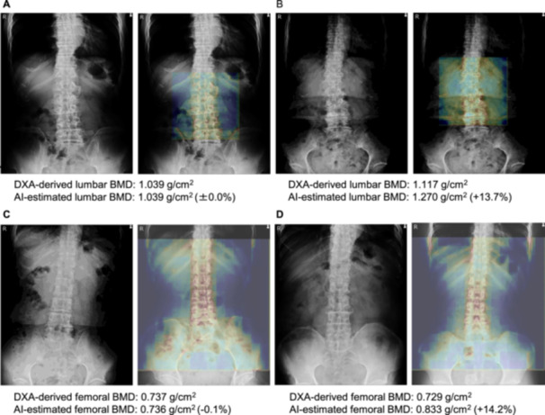 Development of Artificial Intelligence-Assisted Lumbar and Femoral BMD Estimation System Using Anteroposterior Lumbar X-Ray Images.