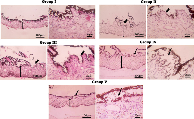 Nano-spanlastics-loaded dissolving microneedle patches for ketotifen fumarate: advanced strategies for allergic conjunctivitis treatment and molecular insights.