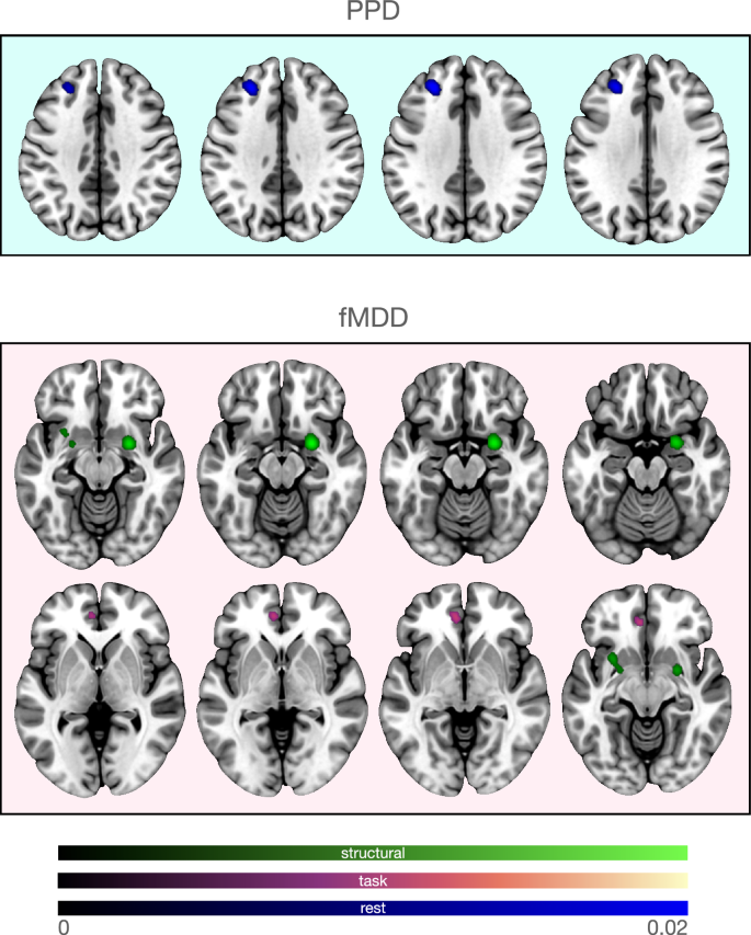 Neural correlates of peripartum depression: a systematic review, meta-analysis and comparison to major depressive disorder