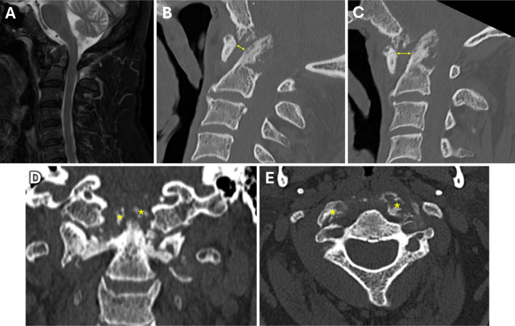 CPPD-related basilar impression with vertebral artery dissection and subsequent subarachnoid hemorrhage: illustrative case.