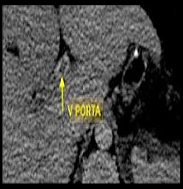 Portomesenteric Vein Thrombosis Following Sleeve Gastrectomy: A Case Report and Literature Review.
