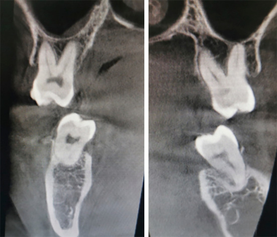 Management of bilateral molar deep overbite with buccal crossbite using bracket-free clear aligners: a case description.