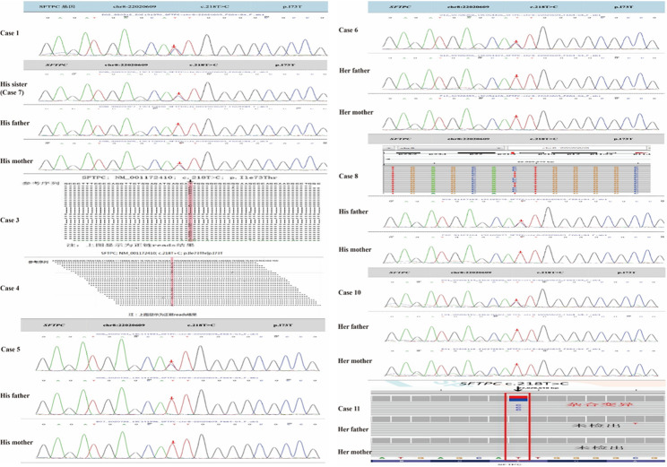 Clinical characteristics of SFTPC gene mutations in children: a single-center experience.