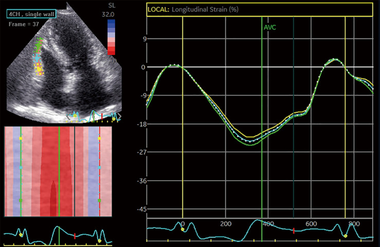 The effect of left atrial reservoir strain on right ventricular dysfunction in left-sided heart failure.