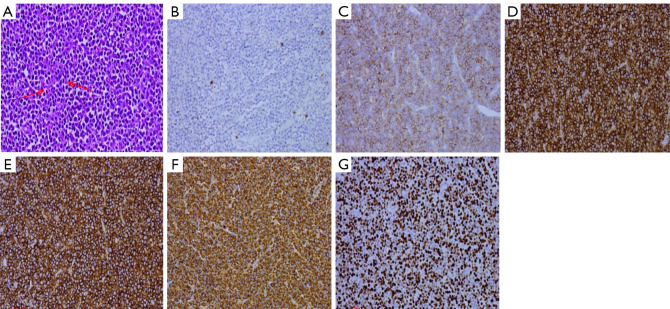 Rare case of recurrent refractory multiple myeloma with lipid deposition in the vertebral body: a case description.