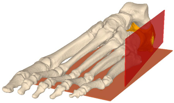 The Importance of the Entry Point and Osteotomy Direction in Calcaneal Lengthening Osteotomy.