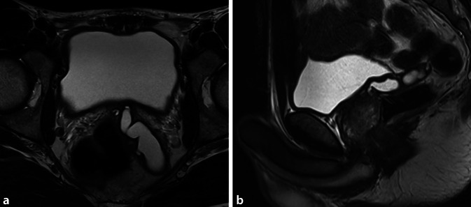 [Occlusive azoospermia in unilateral cystic alteration of the seminal vesicle and contralateral seminal vesicle agenesis-case report].