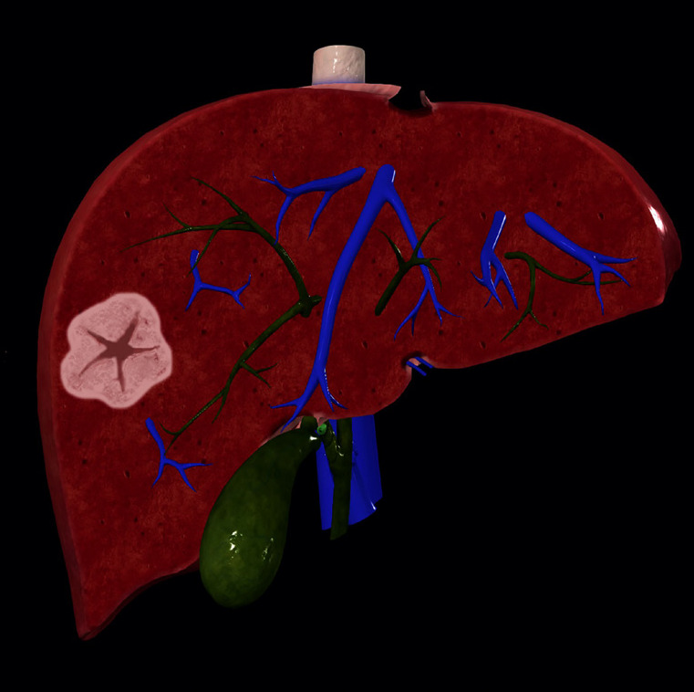 Evaluating artificial intelligence for a focal nodular hyperplasia diagnosis using magnetic resonance imaging: preliminary findings.