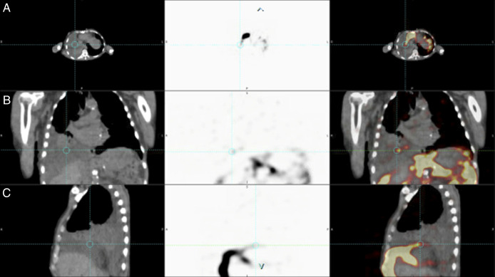 Index Hepatic Decompensation: Hepatic Hydrothorax Without Signs of Clinically Significant Portal Hypertension Diagnosed With Radioisotope Scintigraphy.