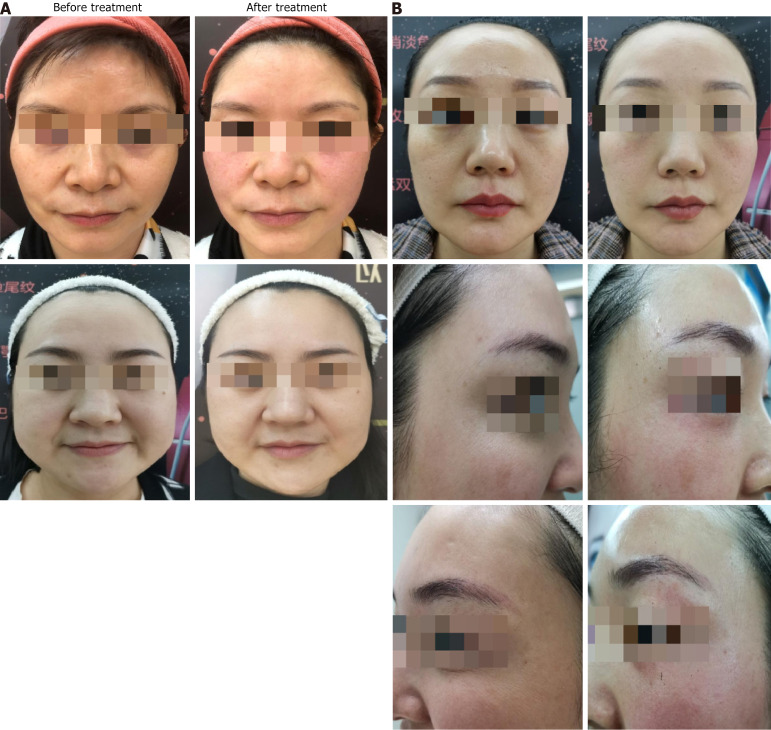 Clinical application of radiofrequency technology in the treatment of facial skin wrinkles and laxity.