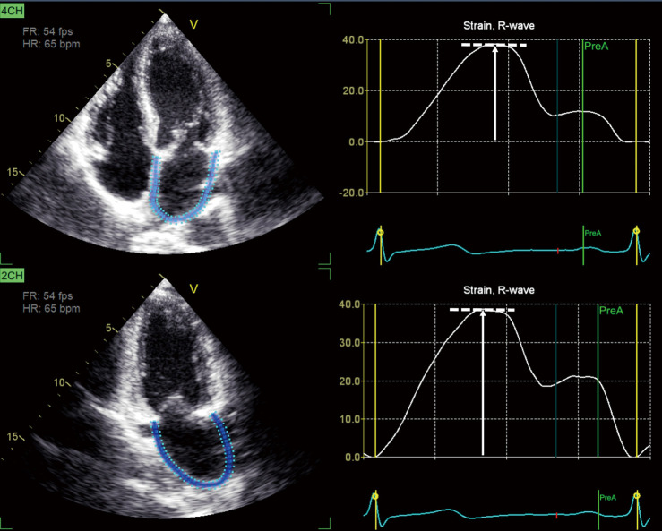 The effect of left atrial reservoir strain on right ventricular dysfunction in left-sided heart failure.