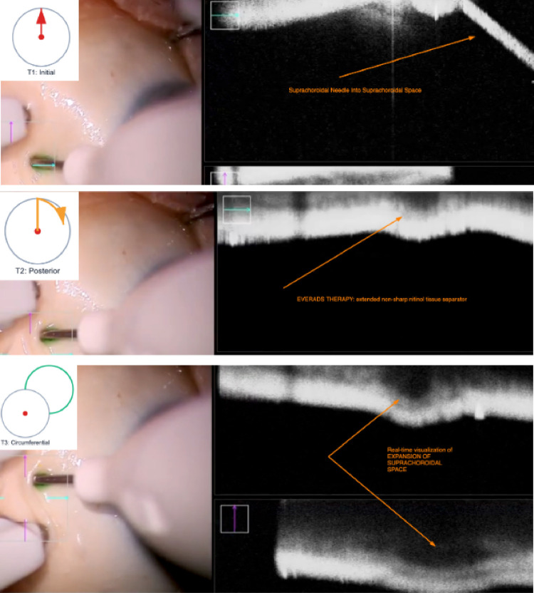 Near-Real Surgical Specimens (NRSS): A Novel Platform for Standardized Assessment of Suprachoroidal Drug Delivery.