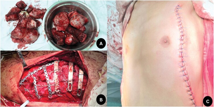 Secondary Asphyxiating Thoracic Dysplasia Due to Multiple Chondromas: A Novel Surgical Report.