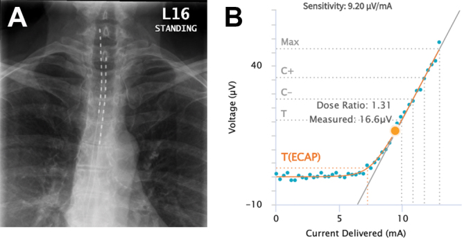 Significant pain reduction in refractory post-mastectomy pain syndrome with closed-loop spinal cord stimulation: illustrative cases.