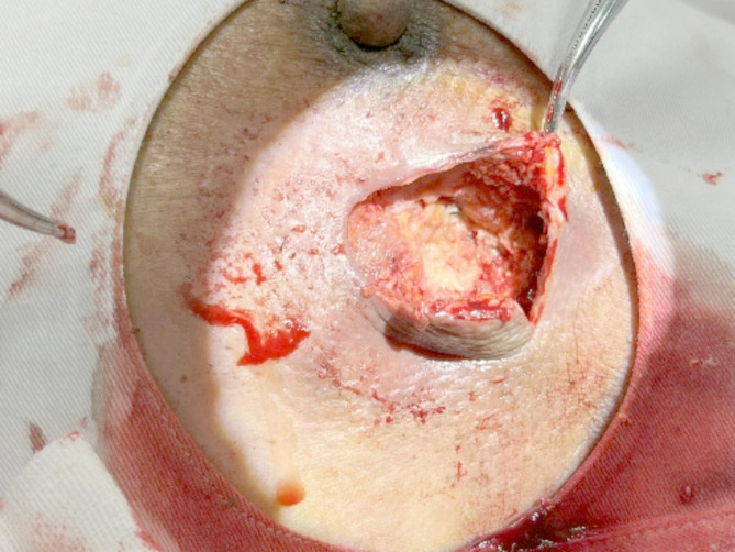 A case report of breast abscess caused by Peptoniphilus harei after endoscopic breast-conserving surgery and radiotherapy for breast cancer and literature review.