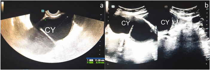Accessory cavitated uterine malformation in a perimenopausal woman: Case report and literature review.