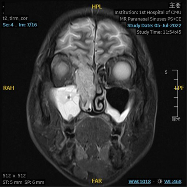 SMARCB1 (INI1)-deficient sinonasal carcinoma with yolk sac differentiation, a case of long-term clinical remission after multiple rounds of radiotherapy-a case report and literature review.