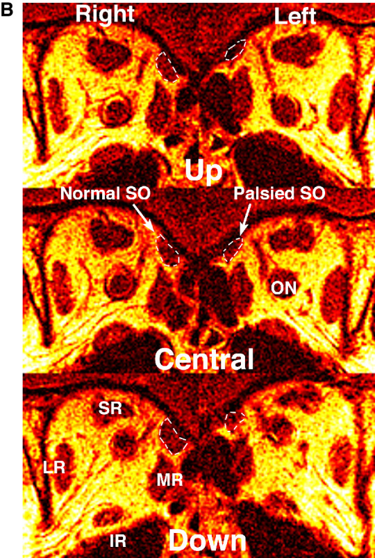 Functional Anatomy of Ocular Counter-Rolling in Superior Oblique Palsy.